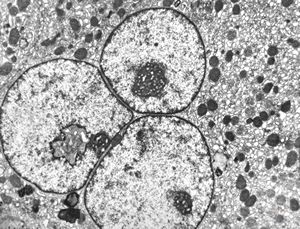 F,61y. | giant cell hepatitis